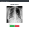 Pneumonia Prediction Using chest x-ray Image Machine Learning